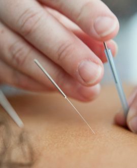 acupuntura-fisioterapia-1